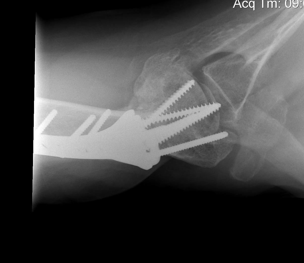 Shoulder AVN Post ORIF Lateral